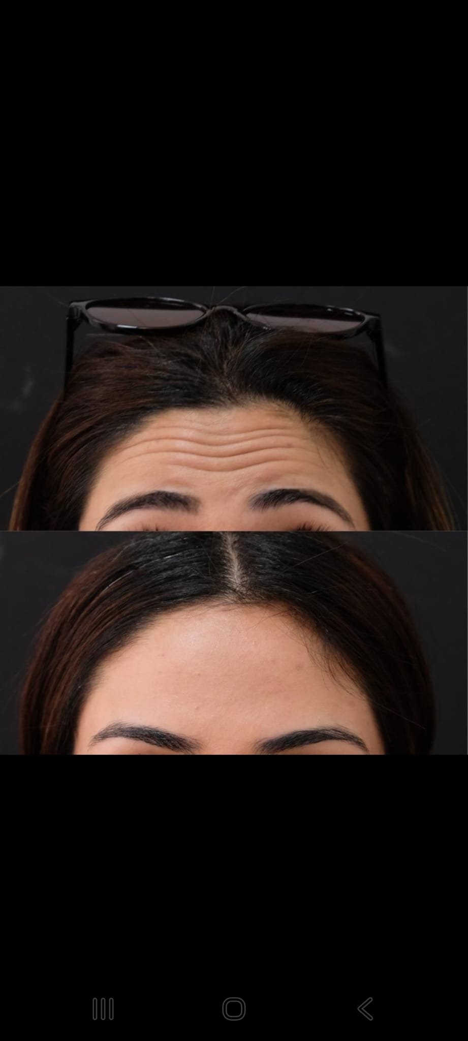 Anti-Wrinkle Before & After